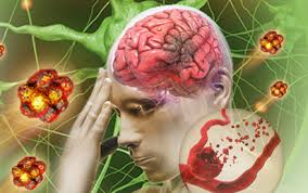 Huyết khối tĩnh mạch não - Hình ảnh minh họa